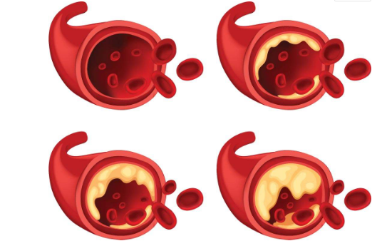 血管堵塞会有哪些表现？