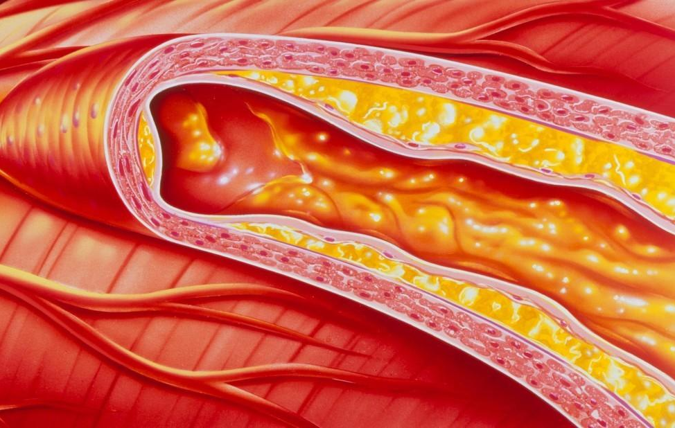动脉粥样硬化的症状表现有哪些？你中招了吗？