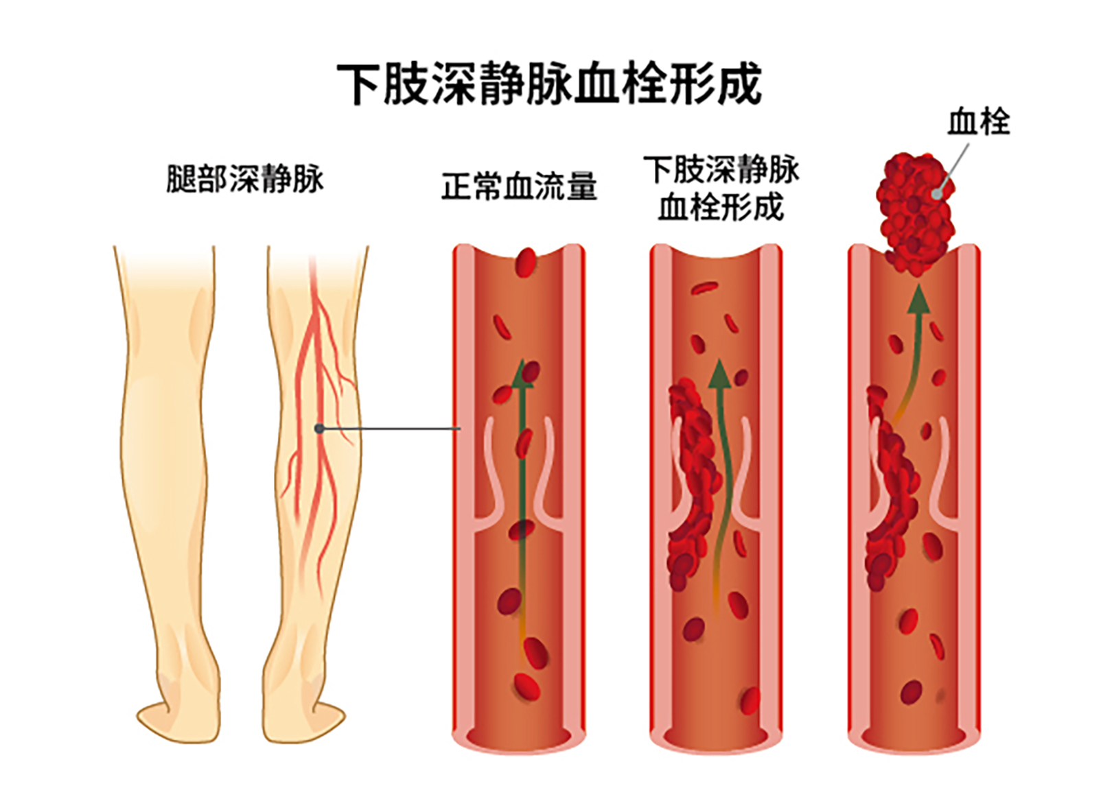 怎么判断身体有没有血栓？