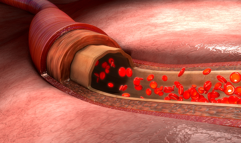 水蛭素帮助控制甘油三酯，远离心梗